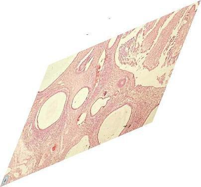 Fig.4 Histologia del tumor - 